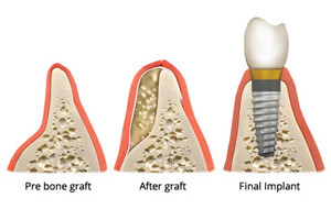 Bone Augmentation-V Care Dental Home, Palakkad