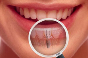 Dental Implants-V Care Dental Home, Palakkad