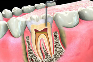 Root Canal-V Care Dental Home, Palakkad